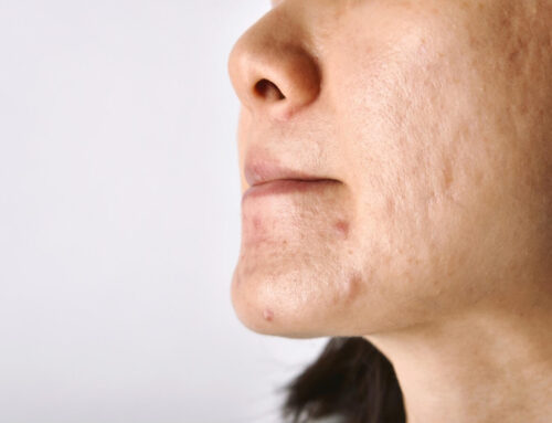 Acne Scars: How to Rid Yourself of These Battle Wounds