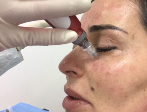 Microneedling PRP: The Holy Grail of Restorative Treatments