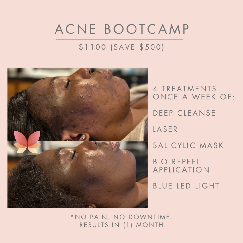 acne boot camp