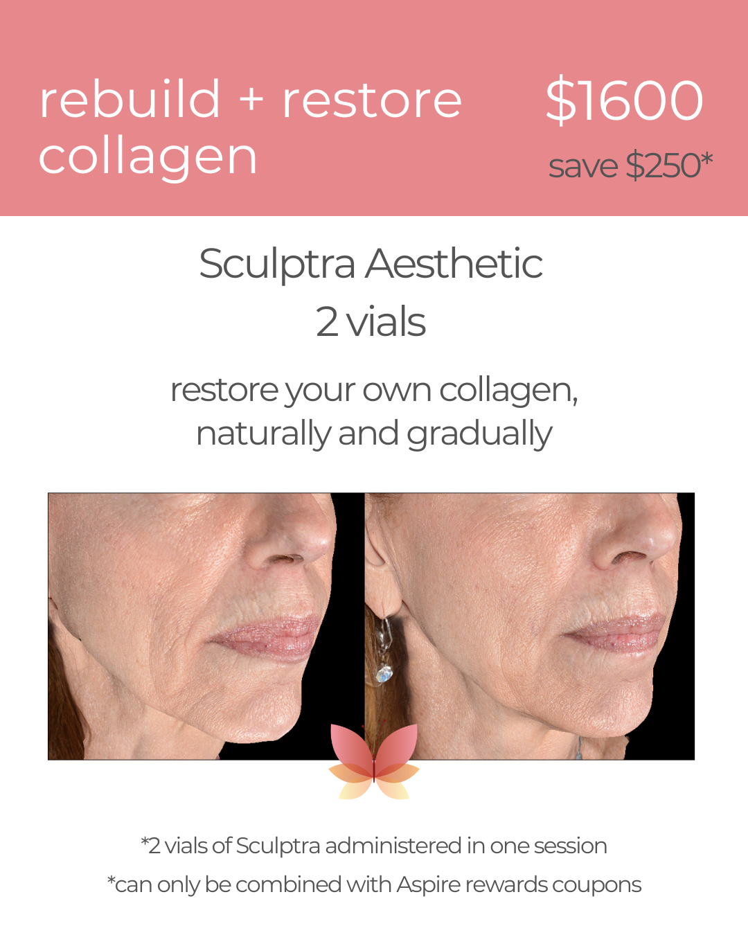 sculptra new